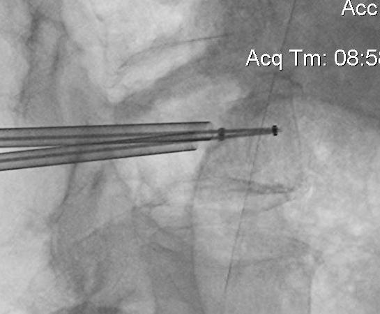 Kyphoplasty Insertion Lateral